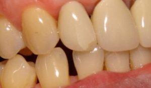 Close-up photo of the upper right lateral incisor crown, showing the cracks forming in the porcelain. If you take away the crack, it was really quite a good looking crown!