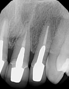 Periapical (PA) x-ray of the upper left teeth. The obturation of the upper left central incisor was short, and the PDL space was slightly widened.