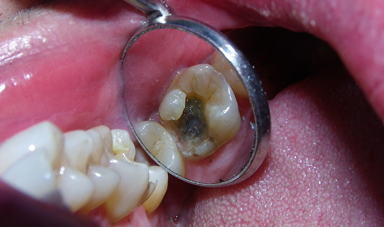 Upper palate and teeth view