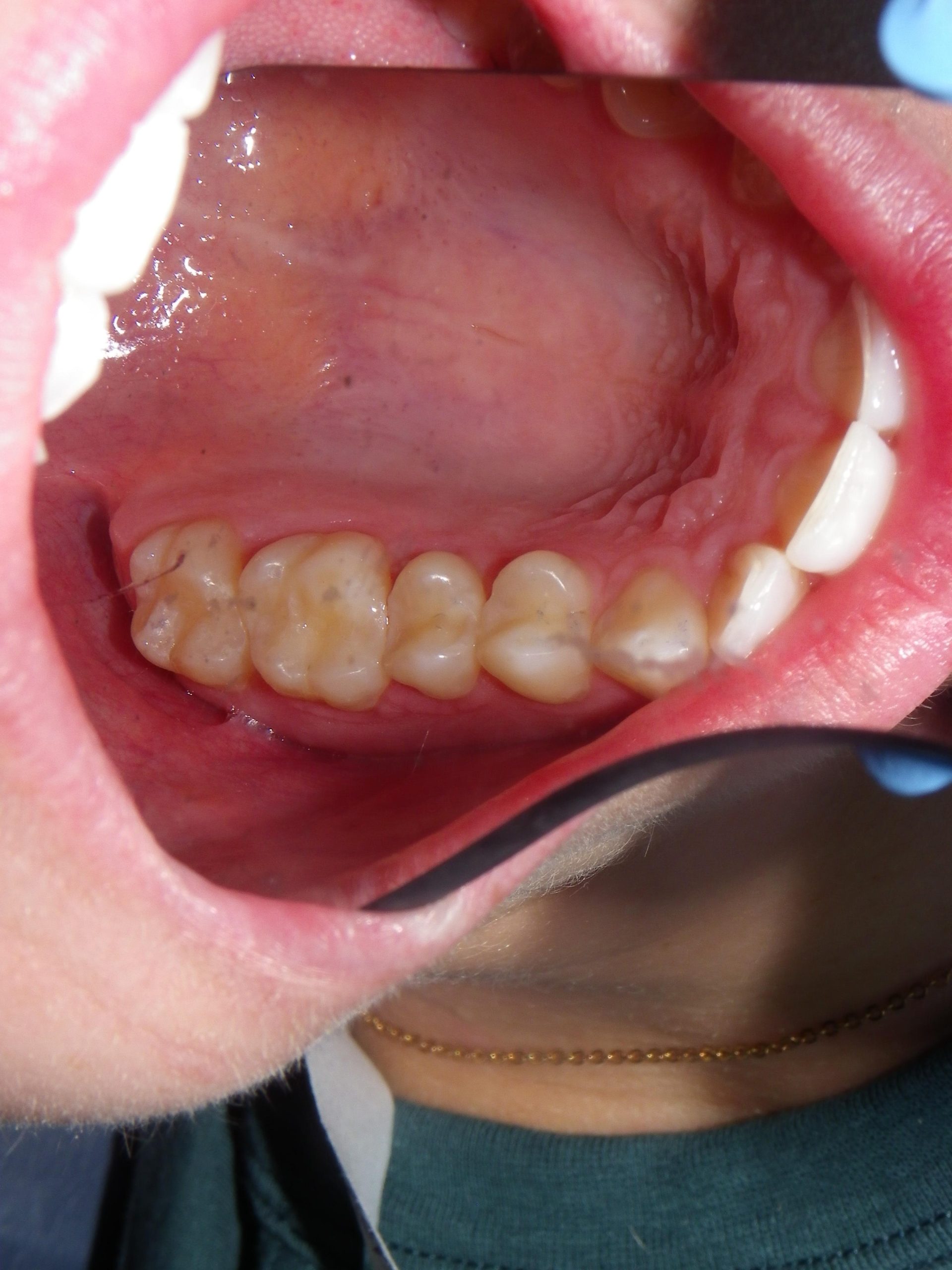 Dental appliance model used for treatment planning