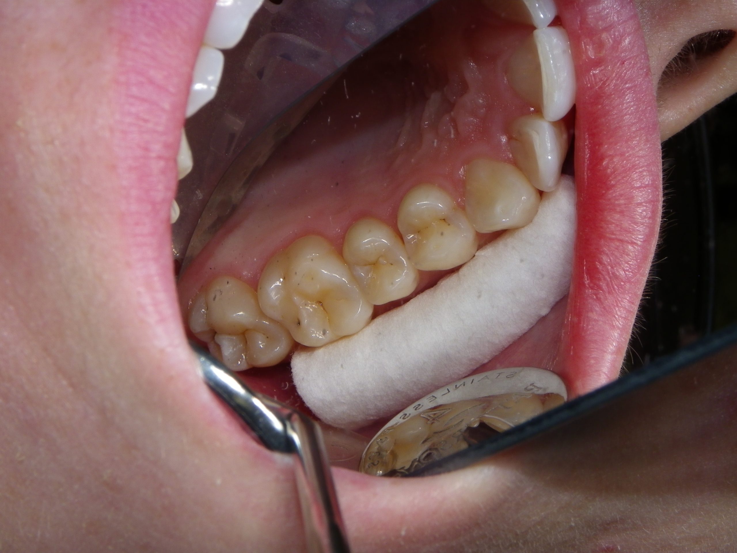 Intraoral view of lower teeth and implants