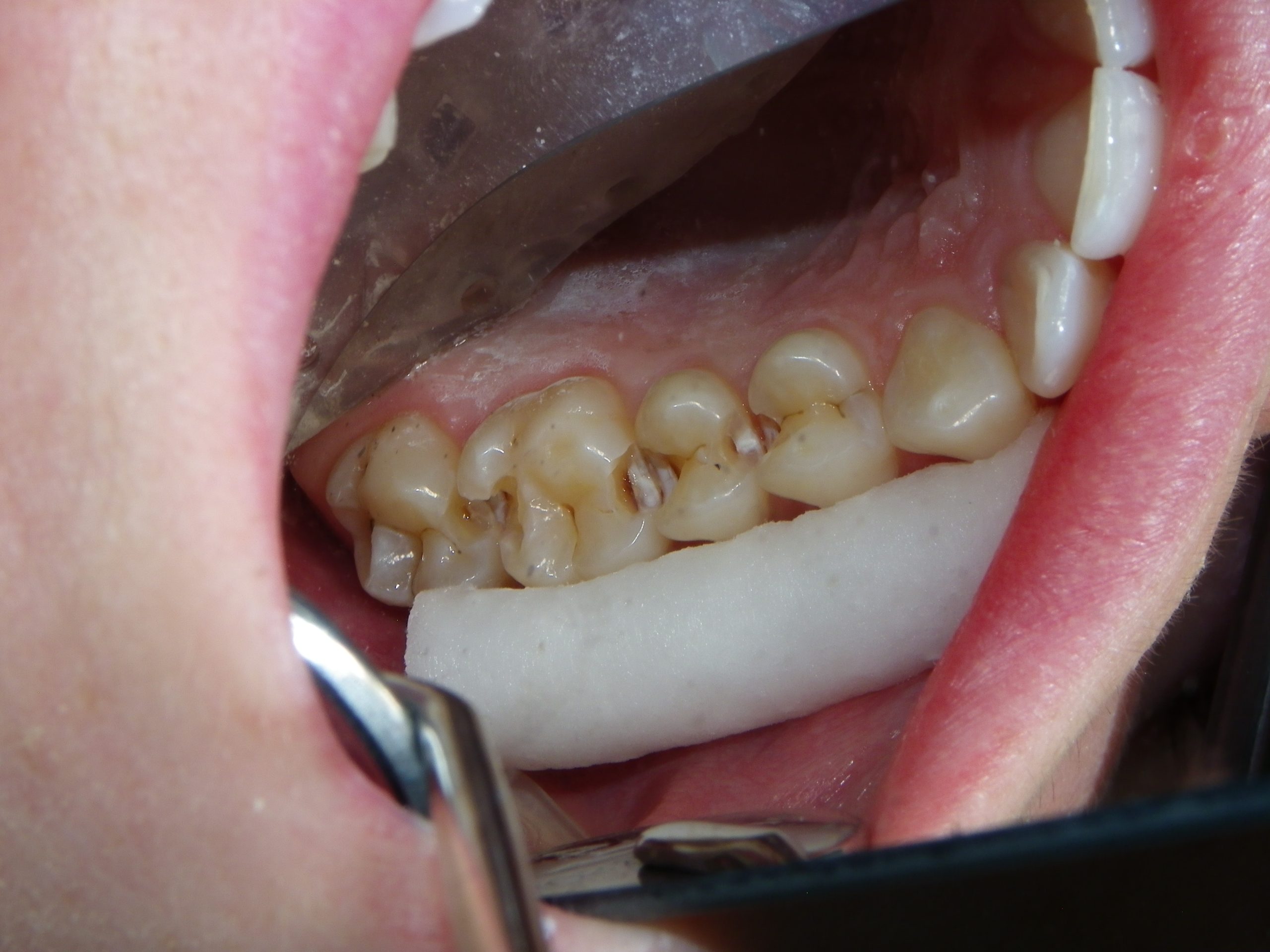 Dental procedure showing implant placement area