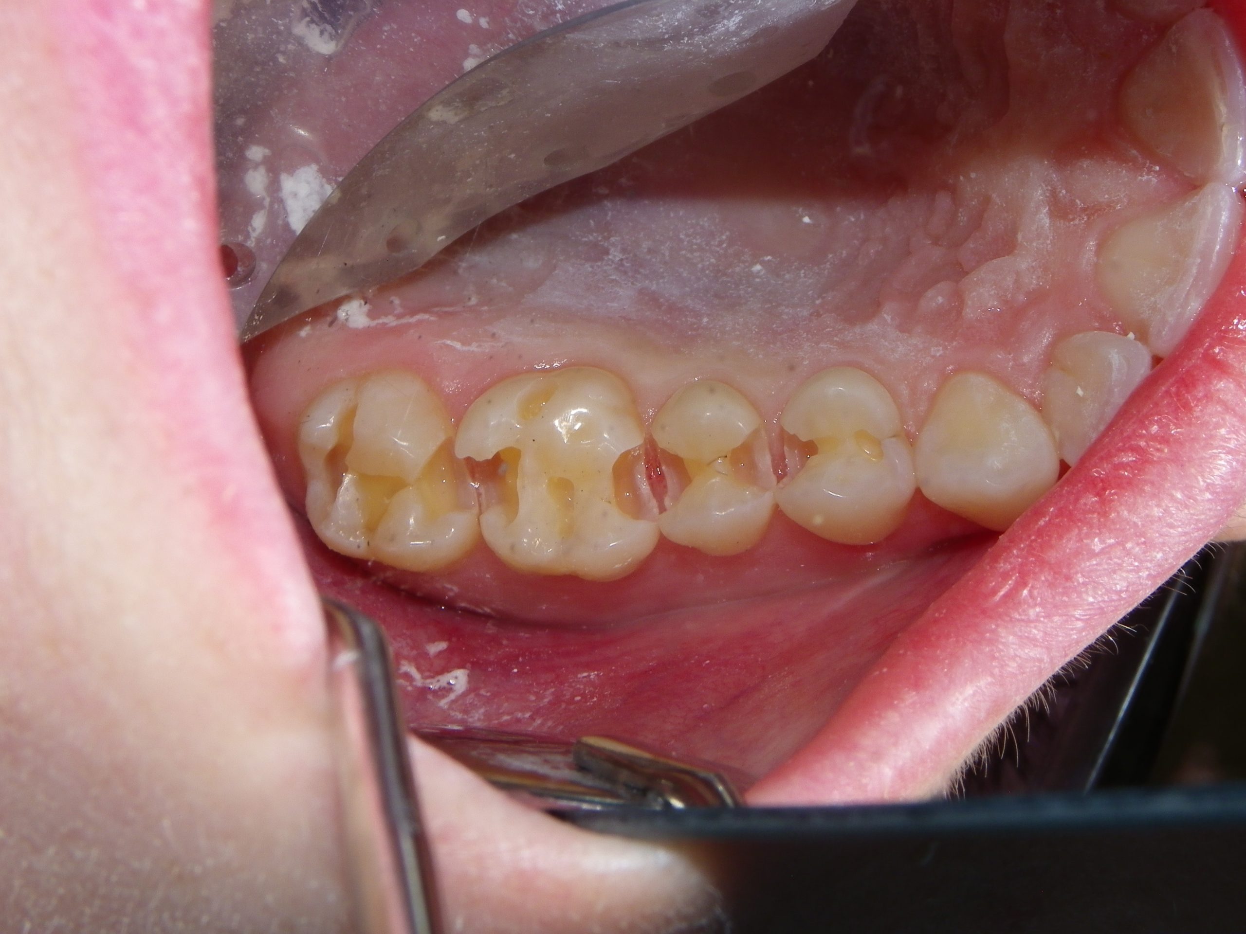 Removable dental prosthetic on display